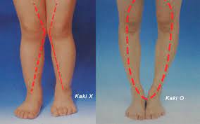 Kebanyakan orang dengan penyakit tulang. Solusi Permasalahan Kelainan Tulang Kaki X Dan O Pada Anak Dan Dewasa Klinik Tulang Belakang