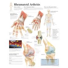 Rheumatoid Arthritis Chart