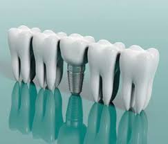 It's my understanding that if the tooth can wiggle from side to side (they all can move slightly front to back) it's pretty much a gonner. Dental Implants Services Replace Teeth In Brampton On