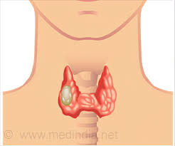 In the united states, it's the tenth most common type of cancer. Papillary Thyroid Cancer Types Risk Factors Diagnosis Treatment