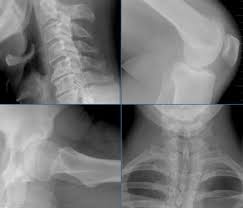 Dabei handelt es sich um eine arthrose der facettengelenke der wirbelsäule, weshalb häufig auch der begriff facettensyndrom verwendet wird. Darstellung Von Wirbelsaule Und Gelenken Digitales Rontgen Und Mrt