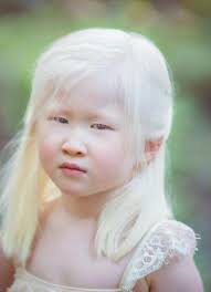 A baby girl born with albinism was abandoned by her parents. She looked too  “weird” for them and left her at an orphanage door. Try not to smile when  you see her