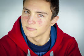 Clear and flawless skin is just as much of a concern among men as it is for women. Acne Young Men S Health