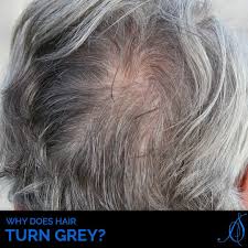 That said, a 2020 study of mice demonstrated how stress can lead to their fur may turn gray under stress. There Is No Scientific Evidence That States That Stress Diet Or Lifestyle Play A Factor In This Grey Hairs Ca Hair Problems Problem Hair Loss Grow Hair Back