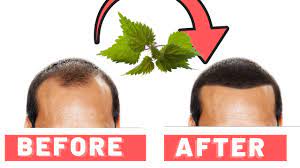 Not only does nettle contain amino acids (the building blocks of collagen) but it's also rich in vitamin c (which stimulates collagen production). Stinging Nettle Root For Hair Loss How It Works Youtube