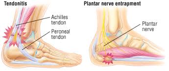 Kick back and let your foot or leg pain heal for several weeks. Heel Pain Harvard Health