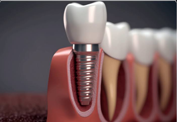 Dental Implants product image