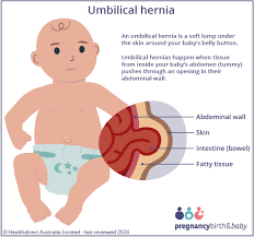 Image result for Inguinal hernia child