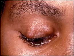 Image result for milium cyst on eyelid