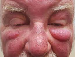 A case report of munchausen syndrome presenting with bleeding from ear. Morbihan Disease Dermnet Nz