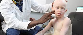 Most melanomas begin in the skin, though they can also occur in the eye. Preventing Skin Cancers Due To Albinism Fondation Pierre Fabre