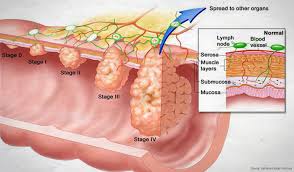 Bowel Cancer Staging Size Position Spread