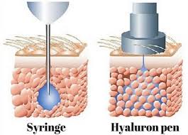 The needleless lip filler uses the same active ingredient as popular needle fillers, such as juvederm and restylane: Hyaluron Pen Needle Free Injections Bella Beauty