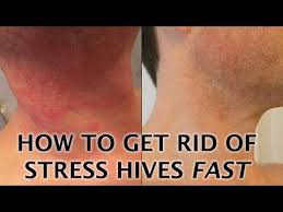 Stress Hives Causes Symptoms And Treatments Of A Stress Rash Home Remedies For Hives Hives Remedies Chronic Hives
