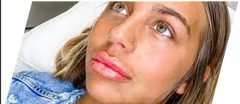 Danielle's lipfillers : r/TLCGypsySisters