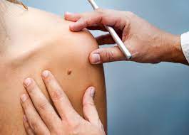 Skin cancer is the most common type of cancer, and finding it early means it is easier to treat. Moma Baby Etc Skin Cancer Cause Symptoms