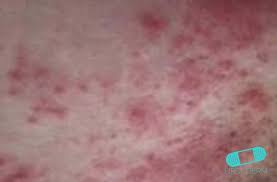 We would like to show you a description here but the site won't allow us. Baltros Herpes Zoster