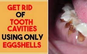 By Using Coconut Oil You Will Be Able To Reverse Cavities And Heal Decomposed Teeth Healthy Daily Life Loose Skin Tighten Loose Skin Tooth Cavity