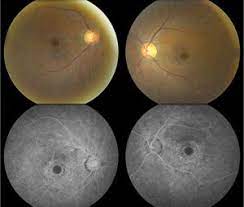 Multimodal Imaging In Plaquenil Toxicity Tea Lights Tea Light Candle Eye Health