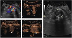 Cranial (head) facial (face) cervical (neck) deltoid (shoulder) pectoral (chest) sternal (center of chest) brachial (arm) antebrachial (forearm) manual (hand) digital (fingers) abdominal (belly. Contrast Enhanced Ultrasound Of The Abdominal Aorta Current Status And Future Perspectives Vasa