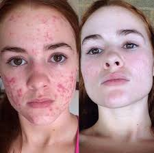 To avoid this, cancel and sign in to youtube on your computer. The Best Accutane Before And After Results Kali Kushner Of Myfacestory