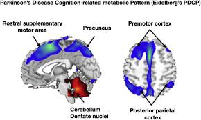If you or a loved one has been diagnosed with parkinson's, you may be wondering about life expectancy. Cognitive Impairment In Parkinson S Disease A Clinical And Pathophysiological Overview Journal Of The Neurological Sciences