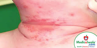 Intertrigo, or intertriginous dermatitis, is a common inflammatory condition of skin folds characterized by moist erythema, malodor, weeping, pruritus intertrigo. Intertrigo