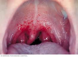 Throat cancer is a general term that applies to cancer that develops in the throat (pharyngeal cancer) or in the voice box (laryngeal cancer). Strep Throat Symptoms And Causes Mayo Clinic