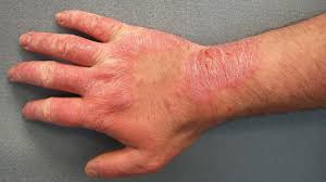 Rash 22 Common Skin Rashes Pictures Causes And Treatment