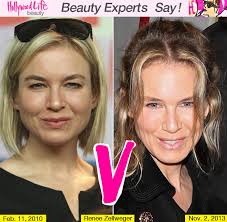 Renee Zellweger's Face — She Got Plastic Surgery, Docs Say