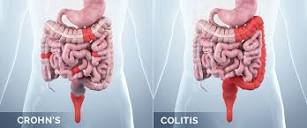 What Is The Difference Between Crohn's Disease And Ulcerative Colitis?