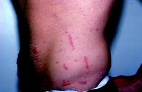 Image result for Rhus Dermatitis