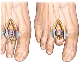 Image result for Metatarsal