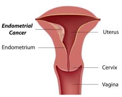 There are many signs of endometrial cancer a woman might experience. What Is Endometrial Cancer Swedish Medical Center Seattle And Issaquah