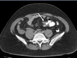 What causes pain in the lower left abdomen? Case Report What Caused Acute Left Side Abdominal Pain In A Healthy Young Man Medpage Today