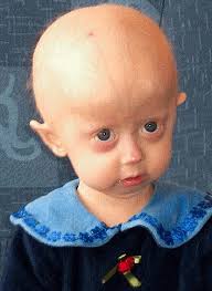 FDA approves first drug to treat rare rapid ageing condition progeria