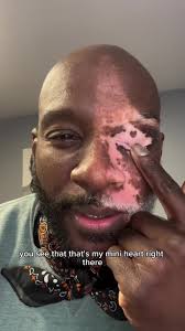 James and his Vitiligo 🐞 #vitiligo #vitiligo_boy #vitiligobeauty #rai...