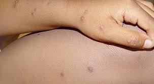 Image result for Papular urticaria