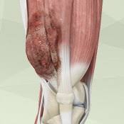 Surgical repair is sometimes necessary. Musculoskeletal Tumor Surgery Dallas Tx Malignant Muscle Tumor Dallas Tx