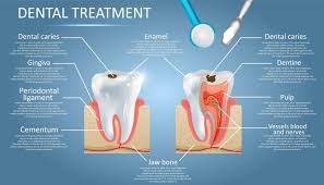 Dental implants, crowns, and bridges 3. Dental Fillings San Diego Dentist Smile Designers Point Loma