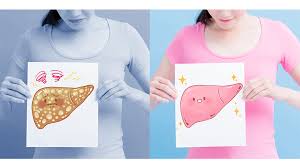 Boala ficatului gras afecteaza extrem de multi oameni la nivel global, fiind una dintre cei mai importanti factori care contribuie la insuficienta hepatica. Ce Trebuie SÄ MÄnanci DacÄ Ai Ficatul Gras Sanatate Sanatate Avantaje Ro De 20 De Ani Pretuieste Femei Ca Tine