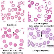 Abnormal Red Blood Cells Morphology And Possible Causes