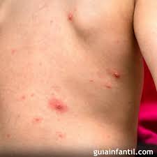 La culebrilla es causada por el mismo virus, el virus de varicela zoster (vzv, por sus siglas en inglés). Que Es La Culebrilla Y Como Afecta A Los Ninos