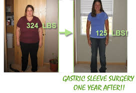 gastric sleeve surgery before and after