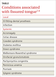 Image result for Fissured tongue