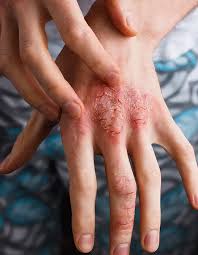 Image result for contact dermatitis
