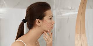 Masa jerawat datang, susah sangat nak hilangkan. Cara Menghilangkan Jerawat Paling Berkesan Hello Doktor