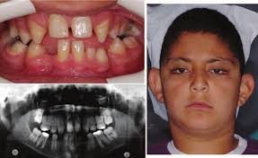 Craniofacial and Dental Characteristics of Kabuki Syndrome: Nine Years  Cephalometric Follow-Up