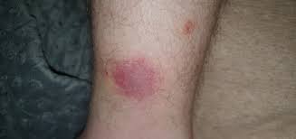 Insektenstich Die Meistgelesenen Fragen