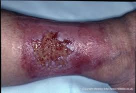 Leg Ulcer With Skin Reaction To Topical Therapy
